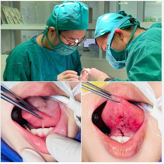 điều trị dính thắng lưỡi tại Quy Nhơn