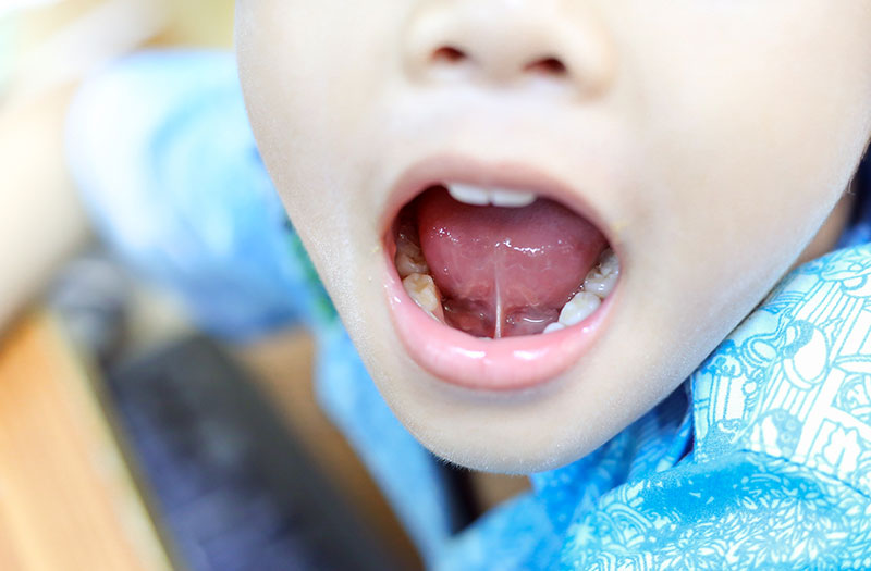 Dấu hiệu nhận biết dính thắng lưỡi