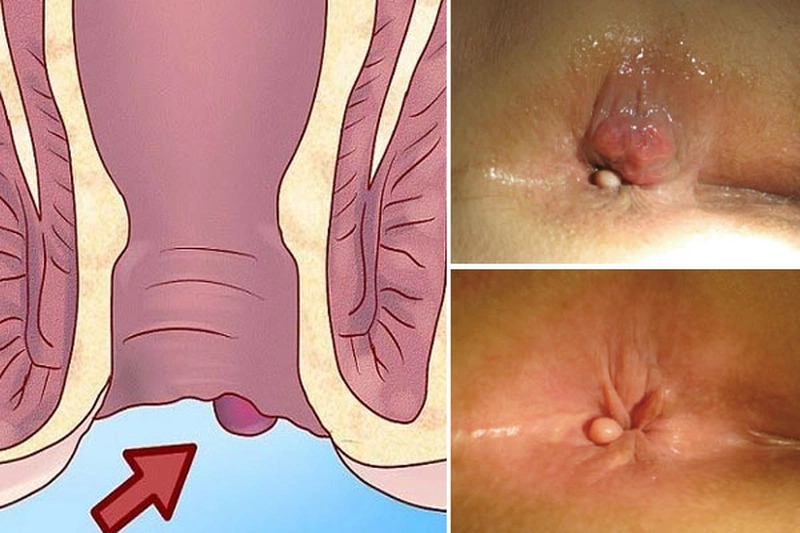 Chi phí khám trĩ bằng laser tại Hà Thành Medic có đắt không?